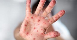 В городе принимают меры по профилактике заболеваемости корью