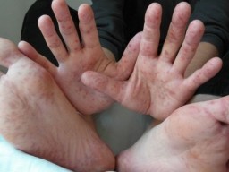 В Минздраве готовятся объявить эпидемию кори в Украине