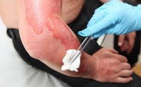 ФОТО: Спасая &laquo;китайца&raquo; 67-летний житель Харьковщины получил ожеги рук и ноги 1 степени (ГСЧС)