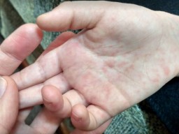 В харьковских вузах и больницах зафиксированы многочисленные вспышки кори