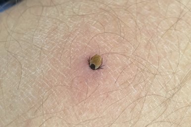  Что делать при укусе клеща. В Минздраве опубликовали инструкцию 